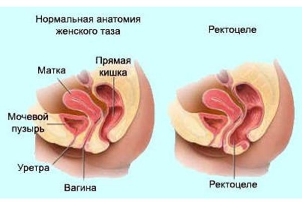Ректоцеле на схеме